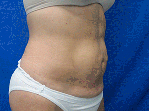 After Image: Patient # 33051 - 