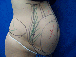 Before Image: Patient # 33051 - 
