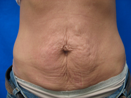 Before Image: Patient # 78387 - 