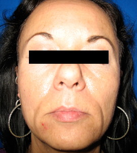 Before Image: Patient # 41575 - 