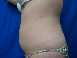 After Image: Patient # 90695 - 