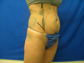 Before Image: Patient # 13083 - 