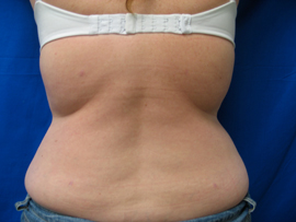 After Image: Patient # 90695 - 