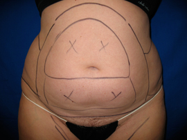 Before Image: Patient # 90695 - 