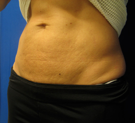Before Image: Patient # 49315 - 