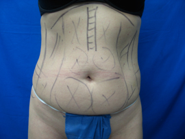 Before Image: Patient # 21908 - 