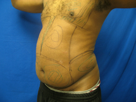 Before Image: Patient # 30878 - 