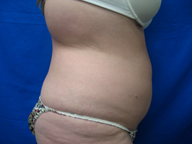 After Image: Patient # 90695 - 