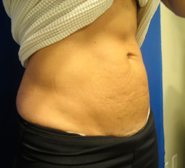 Before Image: Patient # 49315 - 