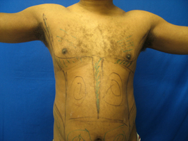 Before Image: Patient # 30878 - 