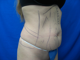 Before Image: Patient # 21908 - 