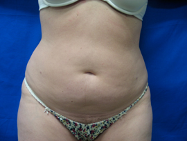 After Image: Patient # 90695 - 