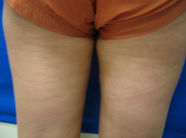 Before Image: Patient # 79992 - 
