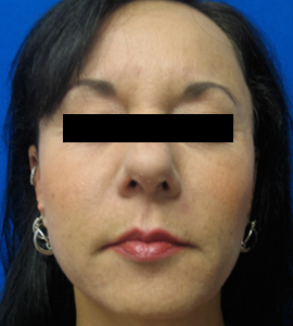 Injectables After Photo