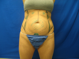 Before Image: Patient # 13083 - 