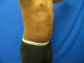 After Image: Patient # 30878 - 