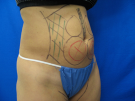 Before Image: Patient # 86159 - 