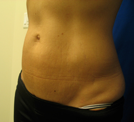 After Image: Patient # 49315 - 