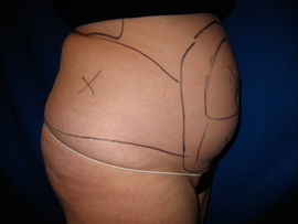 Before Image: Patient # 90695 - 