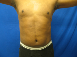 After Image: Patient # 30878 - 