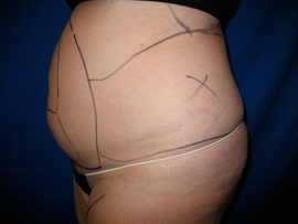 Before Image: Patient # 90695 - 