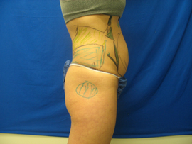 Before Image: Patient # 13083 - 