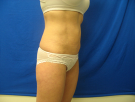 After Image: Patient # 13083 - 