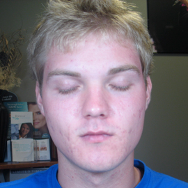 After Image: Patient # 84717 - front