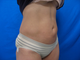 After Image: Patient # 86159 - 
