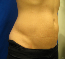 After Image: Patient # 49315 - 