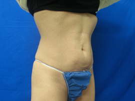 After Image: Patient # 21908 - 