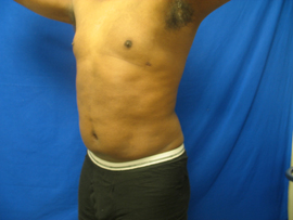 After Image: Patient # 30878 - 