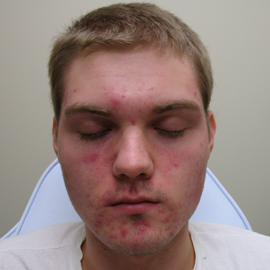Before Image: Patient # 84717 - front