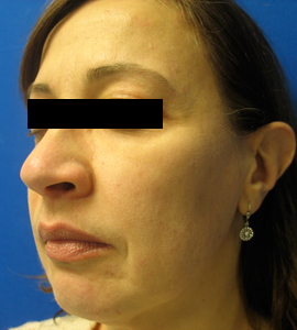 After Image: Patient # 20277 - 