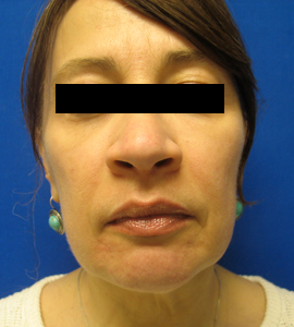 After Image: Patient # 20277 - 