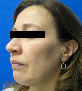 Before Image: Patient # 20277 - 