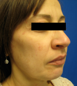 After Image: Patient # 20277 - 