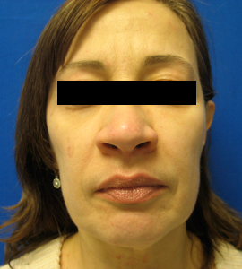 Before Image: Patient # 20277 - 