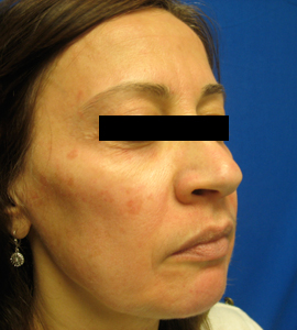 Before Image: Patient # 20277 - 