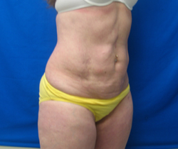 After Image: Patient # 84741 - 