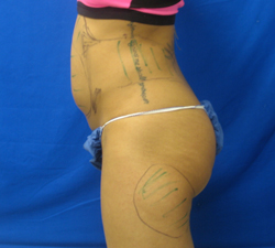 Before Image: Patient # 82059 - 