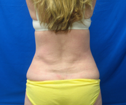 After Image: Patient # 84741 - 