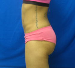 After Image: Patient # 82059 - 