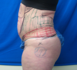 Before Image: Patient # 84741 - 