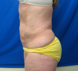 After Image: Patient # 84741 - 