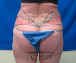 Before Image: Patient # 84741 - 