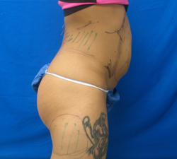 Before Image: Patient # 82059 - 