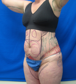 Before Image: Patient # 84741 - 