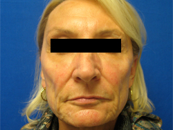 Before Image: Patient # 11582 - 