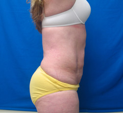 After Image: Patient # 84741 - 